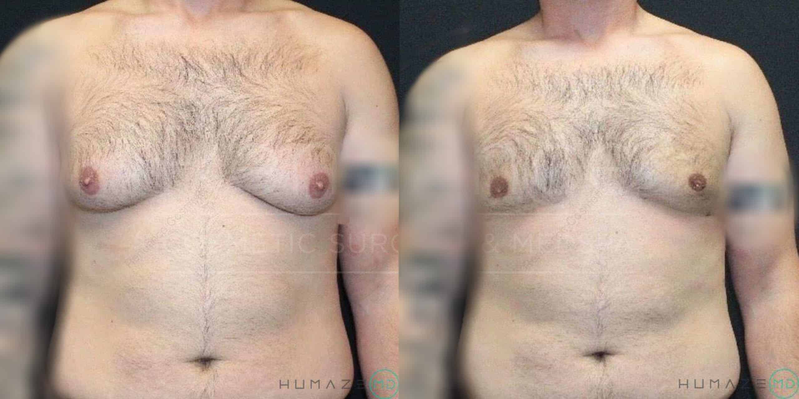 A before-and-after comparison of a man's chest. The left side shows the chest with more excess tissue, while the right side shows a more toned and flattened chest after a surgical procedure. Both images have pixelated areas covering parts of the arms and lower abdomen. The background is a plain dark color.