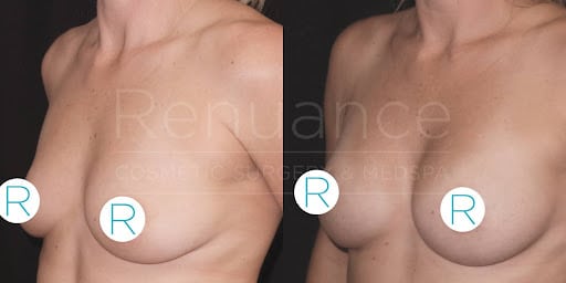Before and after comparison images of a woman's chest, showing the results of a cosmetic breast procedure with a labeled identifier "R" on both images. The "before" image on the left shows larger breasts while the "after" image on the right shows smaller, lifted breasts. The background is black, and there is faint text overlay saying "Renuance."