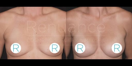 Before and after images of a person who underwent breast augmentation surgery. The before image is on the left, and the after image is on the right, showing changes in breast size and appearance. The text "Renuance Cosmetic Surgery Centre" is faintly visible in the background. Each breast is marked with a letter "R" inside a circle.