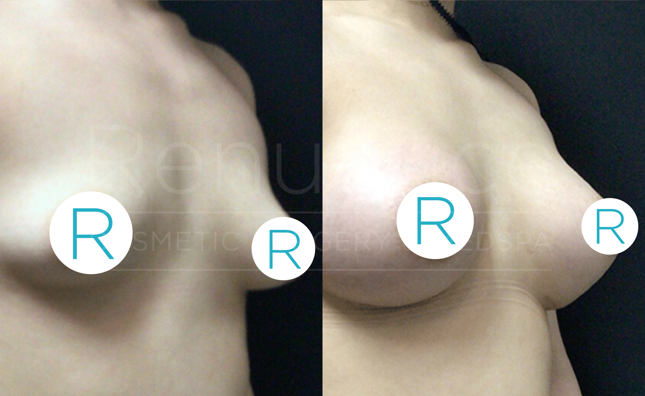 A split image showing a before-and-after comparison of a breast augmentation procedure. The left side shows the breasts before surgery, appearing smaller and less defined. The right side shows the breasts after surgery, appearing fuller and more rounded. Both images have a circular "R" symbol with a blue border covering part of the breast area.