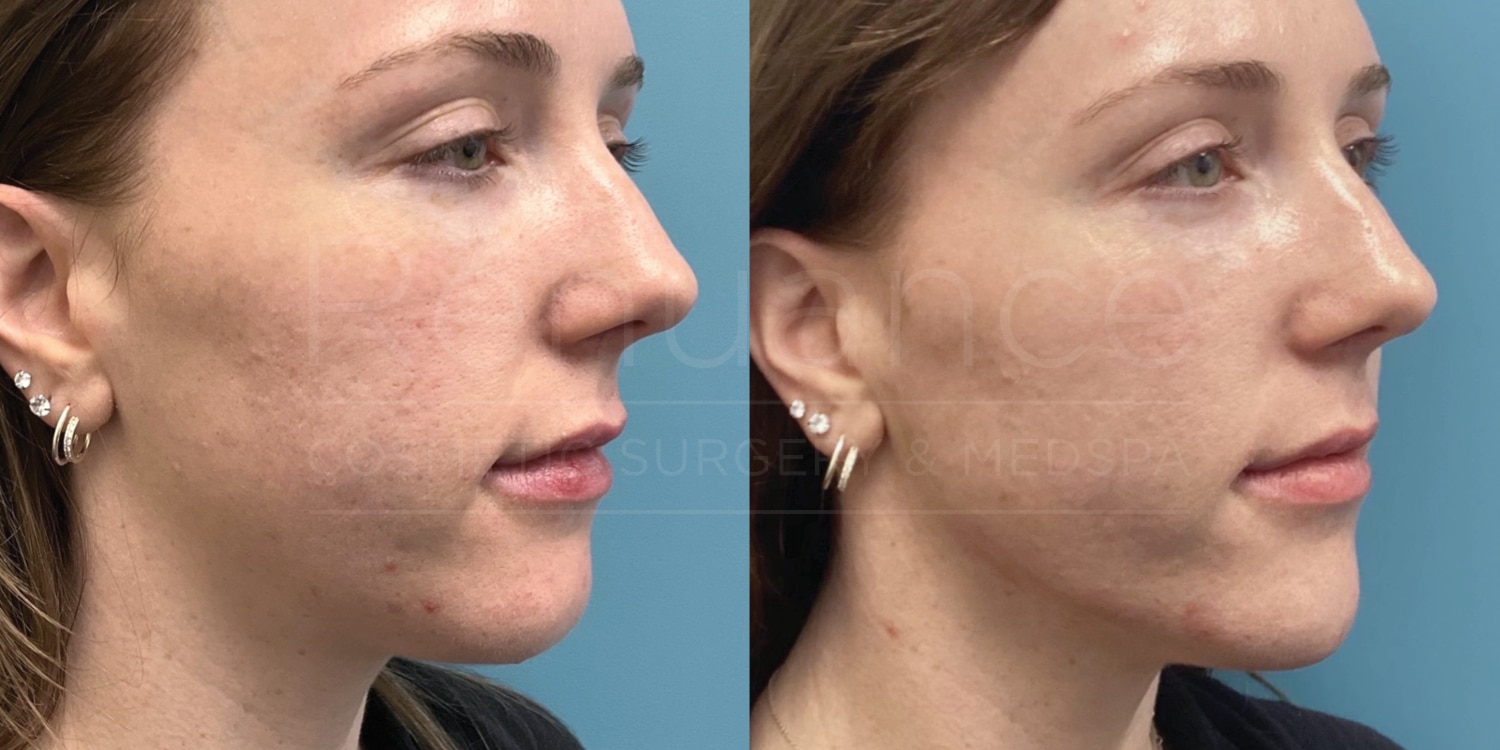 chin implants before and after