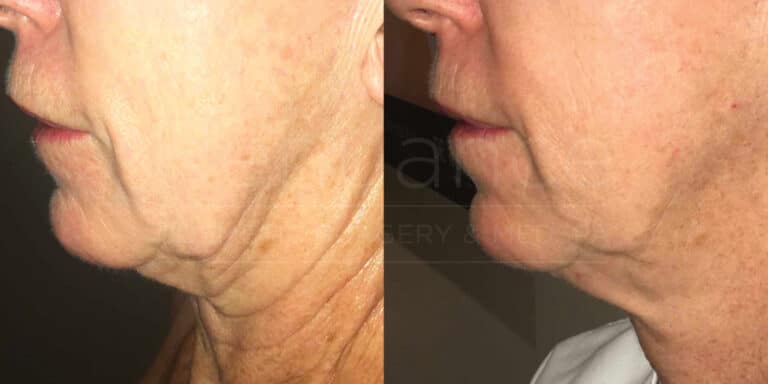 morpheus8 before and after