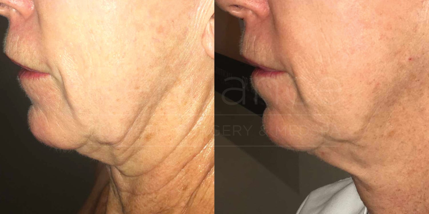 morpheus8 before and after