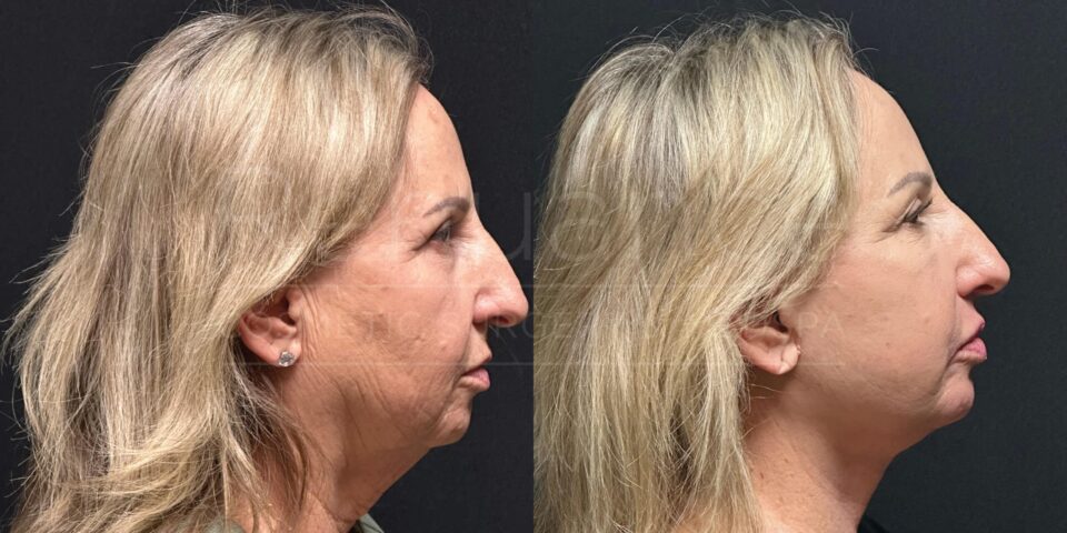 deep plane facelift before and after the procedure