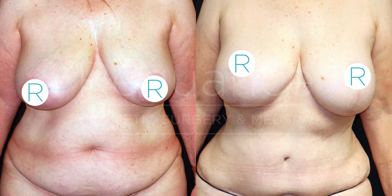 Before and after of a breast lift procedure performed at Renuance Temecula