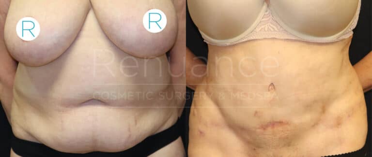 Before and after tummy tuck and liposuction performed by Dr. Hill at Renuance