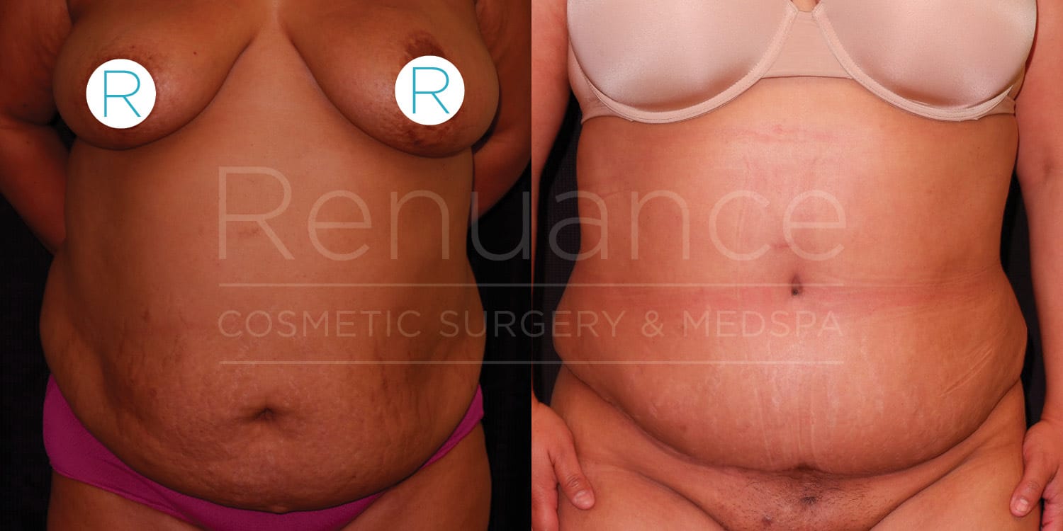 Before and after of a tummy tuck and rhinoplasty, performed at Renuance Murrieta