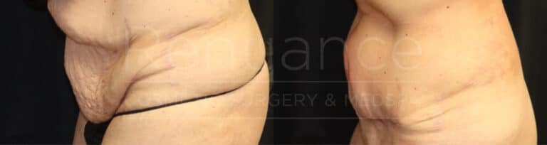 Liposuction and tummy tuck, results of a combination procedure