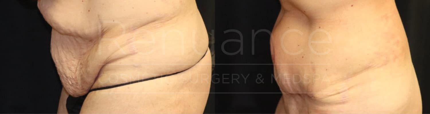 Liposuction and tummy tuck, results of a combination procedure