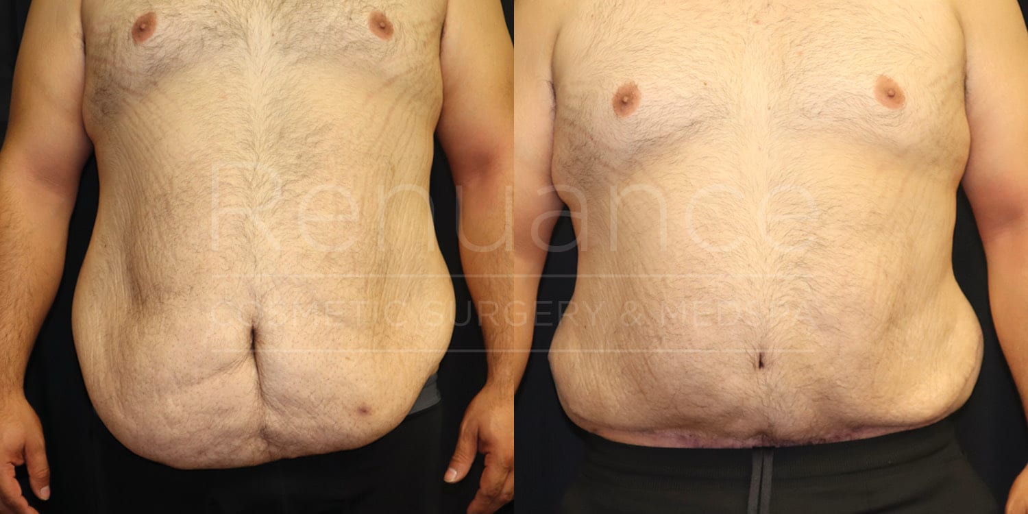 Before and after excess skin removal and liposuction results from our Temecula clinic