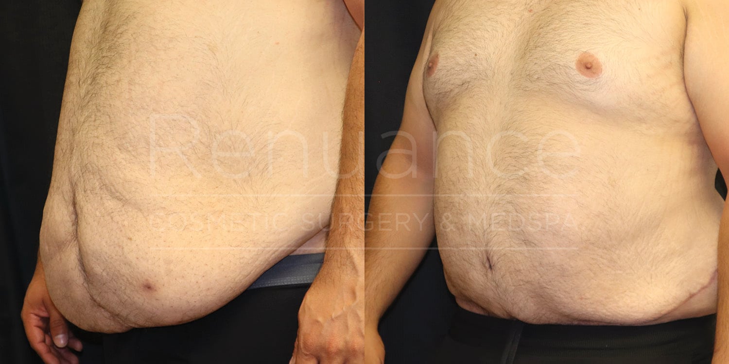 Before and after body contouring showing combined excess skin removal and liposuction