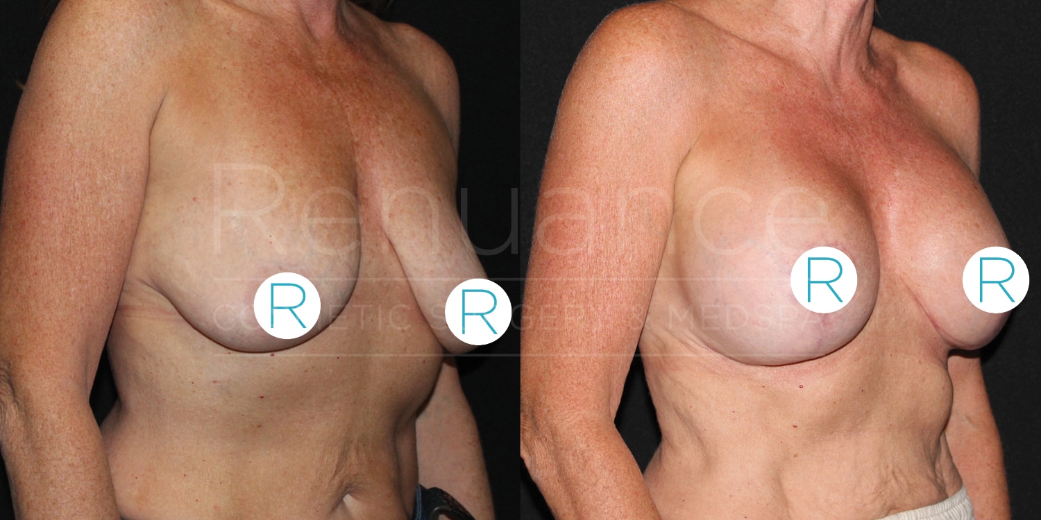 Renuance-1506343038-Before-After-Mastopexy-with-augmentation-Breast-lift-with-implants-dr-ford-405cc-10-07-2024- (2)