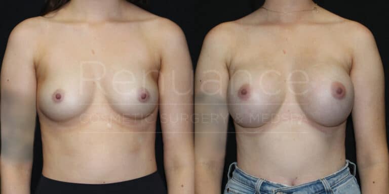 Renuance-1506343038-Before-After-breast-augmentation-dr-ford-28-yo-120-lbs-silicone-325cc-10-07-2024