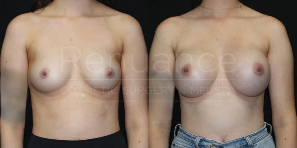 Renuance-1506343038-Before-After-breast-augmentation-dr-ford-28-yo-120-lbs-silicone-325cc-10-07-2024