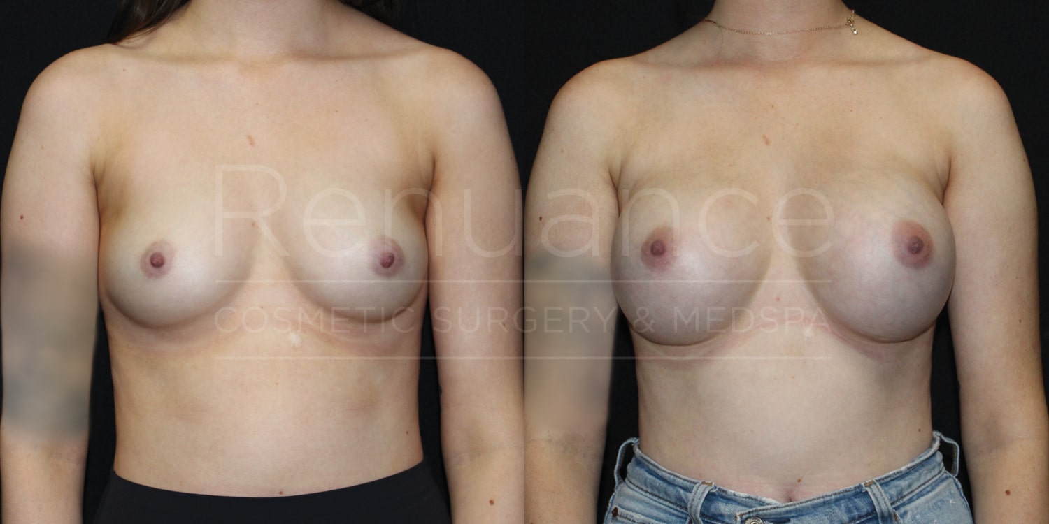 Renuance-1506343038-Before-After-breast-augmentation-dr-ford-28-yo-120-lbs-silicone-325cc-10-07-2024