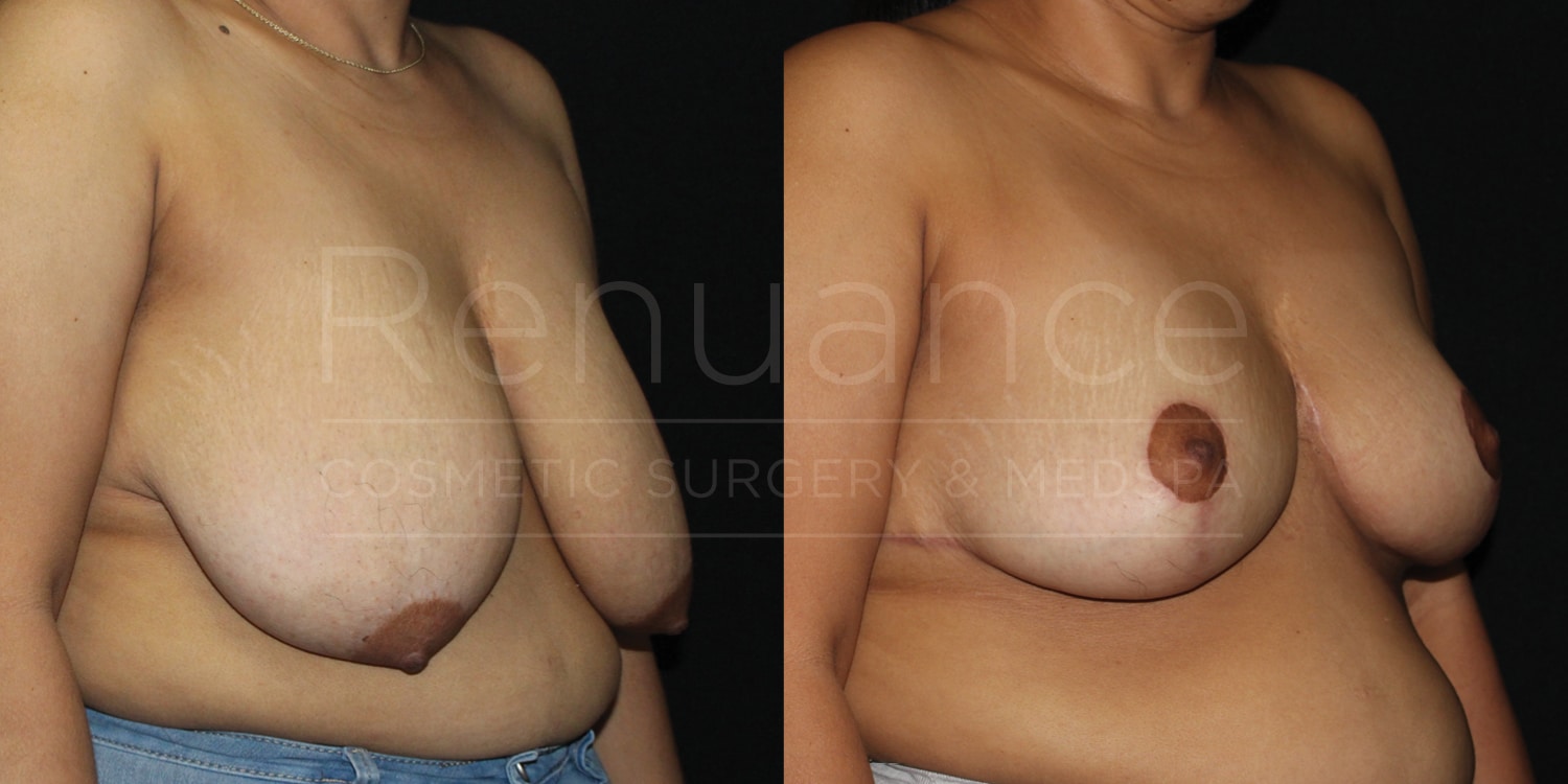 Renuance-1506343038-Before-After-breast-reduction-dr-ford-41-yo-170-lbs-10-07-2024 - (1)