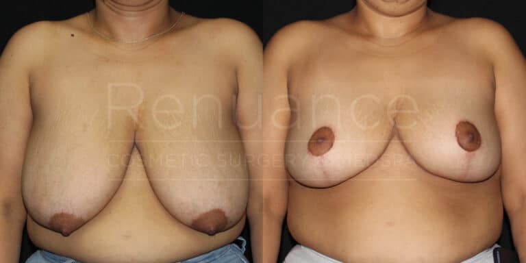 Renuance-1506343038-Before-After-breast-reduction-dr-ford-41-yo-170-lbs-10-07-2024