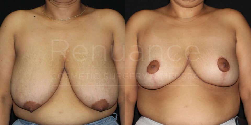 Renuance-1506343038-Before-After-breast-reduction-dr-ford-41-yo-170-lbs-10-07-2024