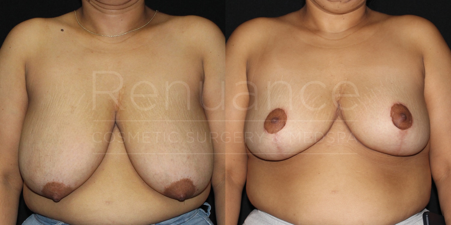 Renuance-1506343038-Before-After-breast-reduction-dr-ford-41-yo-170-lbs-10-07-2024