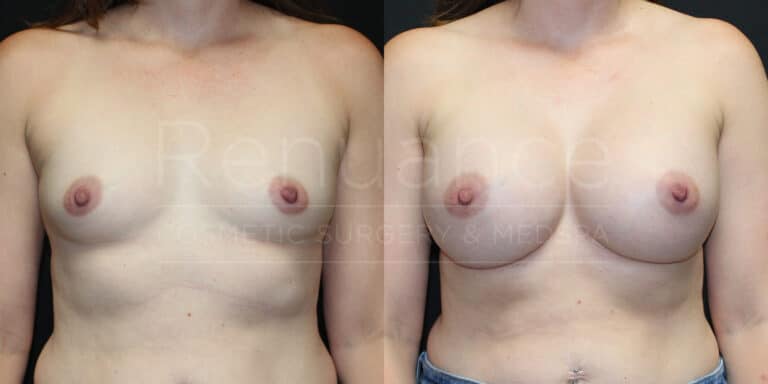 Breast Augmentation Before and After photos performed by Dr. Rachel S. Ford