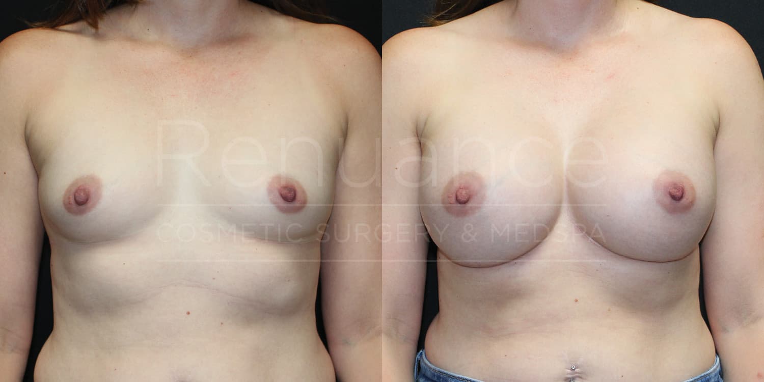 Breast Augmentation Before and After photos performed by Dr. Rachel S. Ford