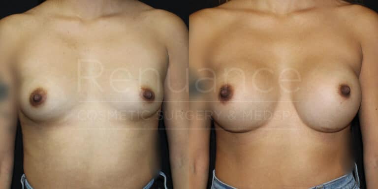 Breast Augmentation Before and After photos performed by Dr. Rachel S. Ford