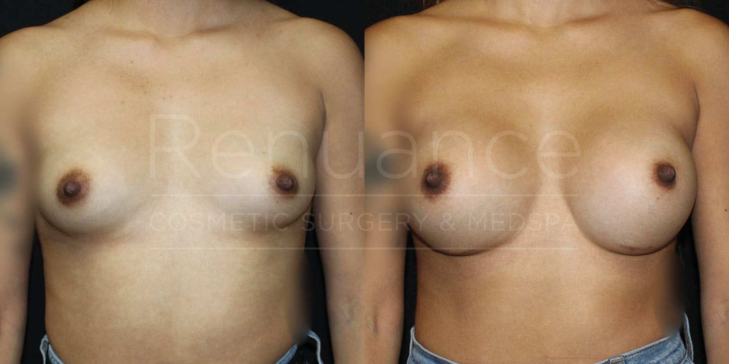 Breast Augmentation Before and After photos performed by Dr. Rachel S. Ford