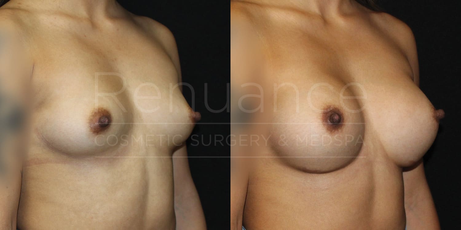 Breast Augmentation Before and After photos performed by Dr. Rachel S. Ford
