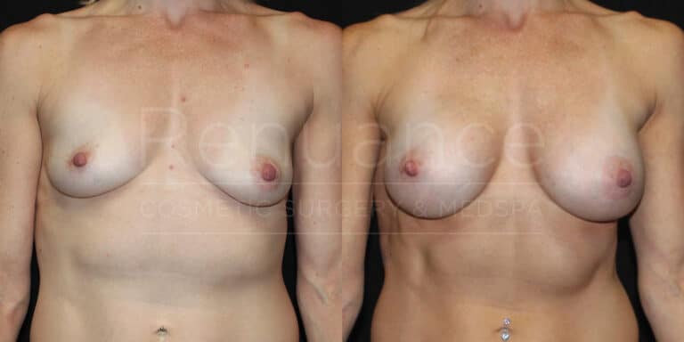 Breast Augmentation Before and After photos performed by Dr. Rachel S. Ford