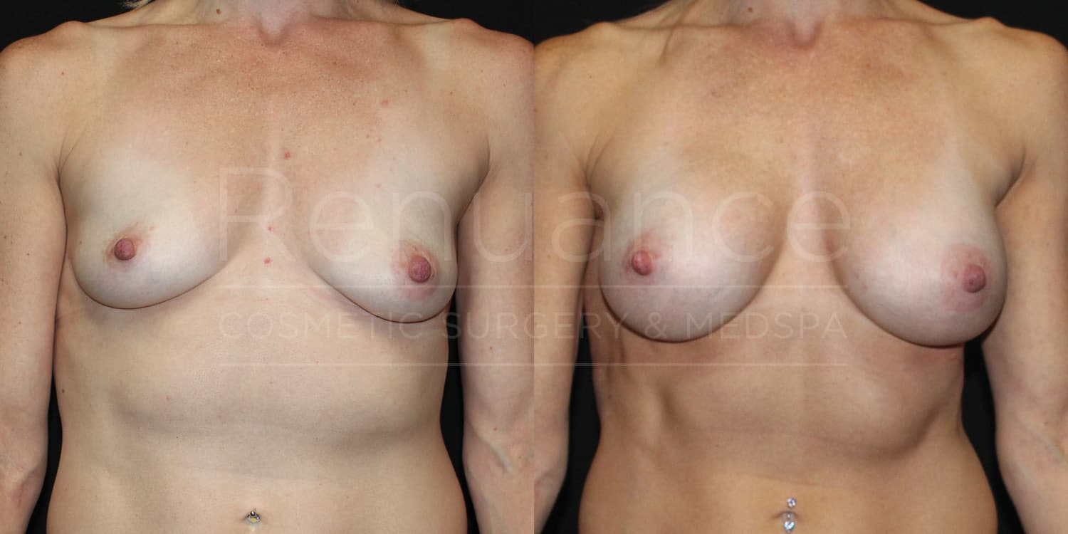 Breast Augmentation Before and After photos performed by Dr. Rachel S. Ford