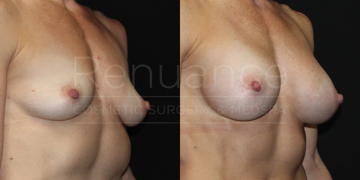 Breast Augmentation Before and After photos performed by Dr. Rachel S. Ford