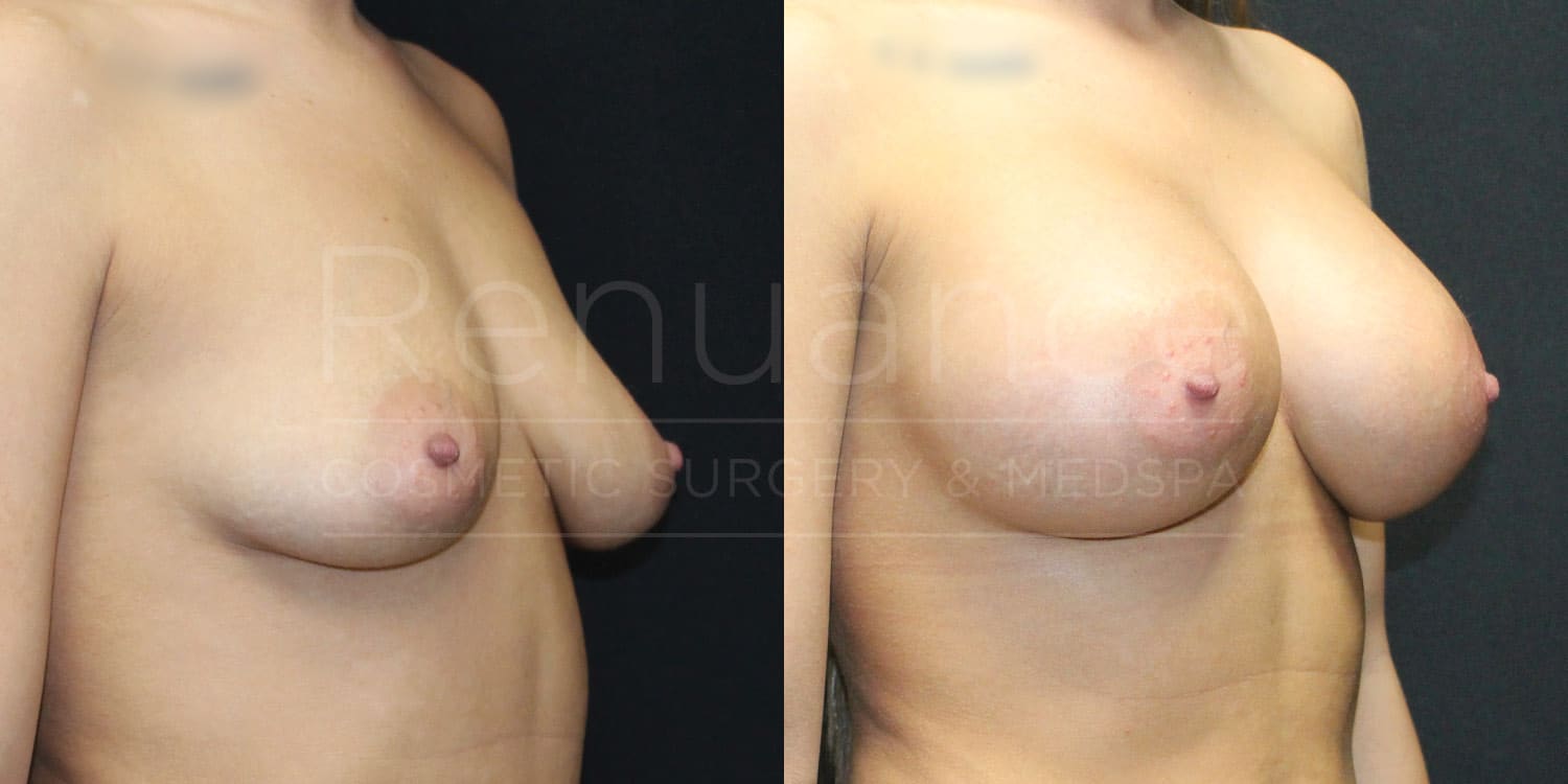 Breast Augmentation Before and After photos performed by Dr. Rachel S. Ford