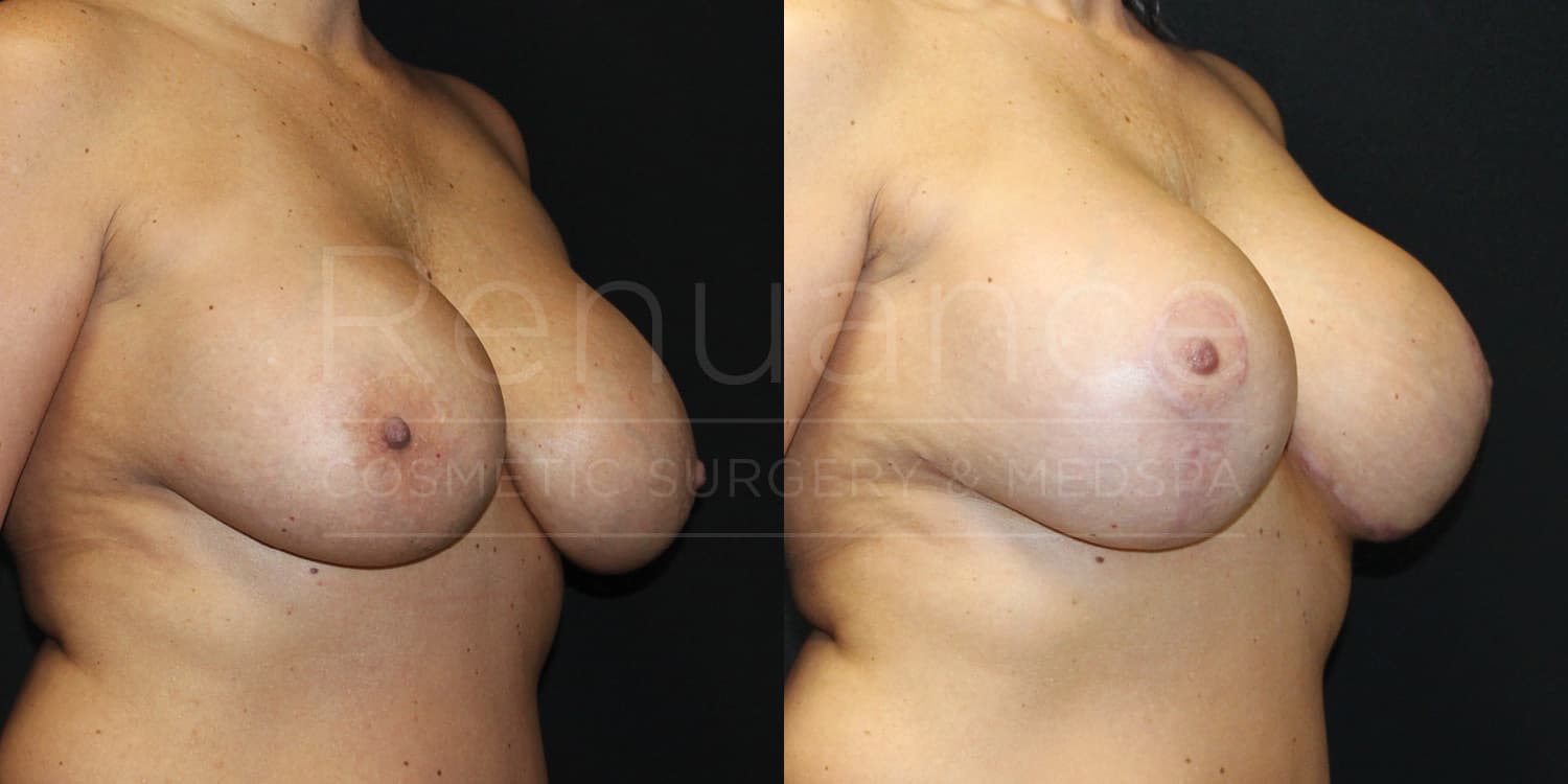 Breast Implant Exchange and Breast Lift Before and After photos performed by Dr. Rachel S. Ford