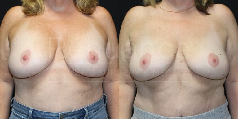 Breast Implant Removal (Explant) and Breast Lift Before and After photos performed by Dr. Rachel S. Ford