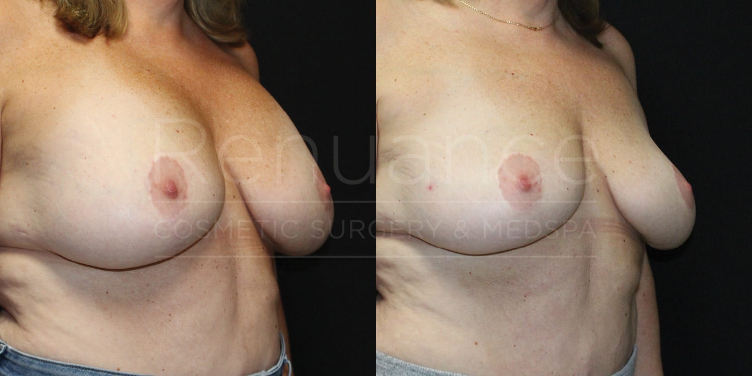 Breast Implant Removal (Explant) and Breast Lift Before and After photos performed by Dr. Rachel S. Ford