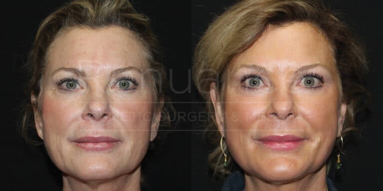 CO2 Laser Resurfacing Before and After photos performed by Dr. Rachel S. Ford