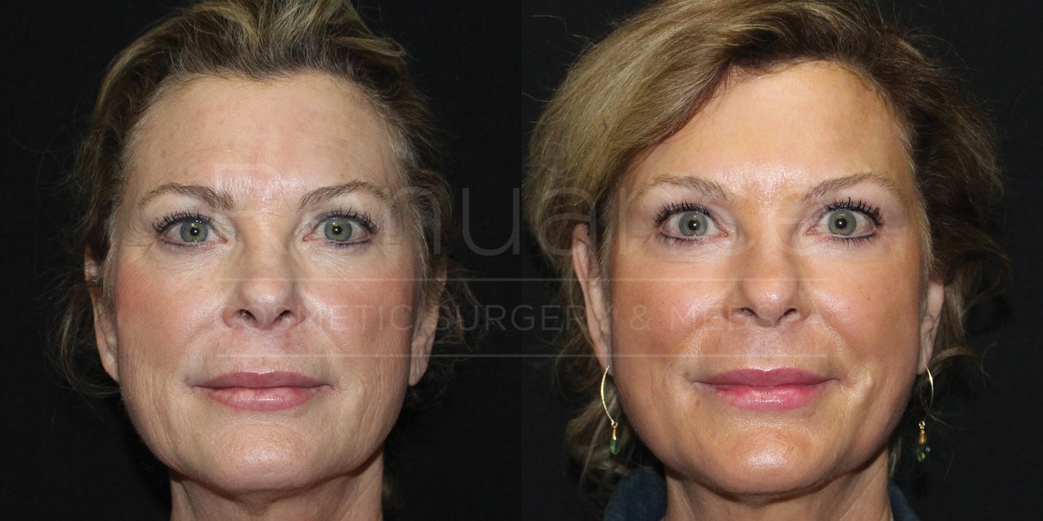 CO2 Laser Resurfacing Before and After photos performed by Dr. Rachel S. Ford
