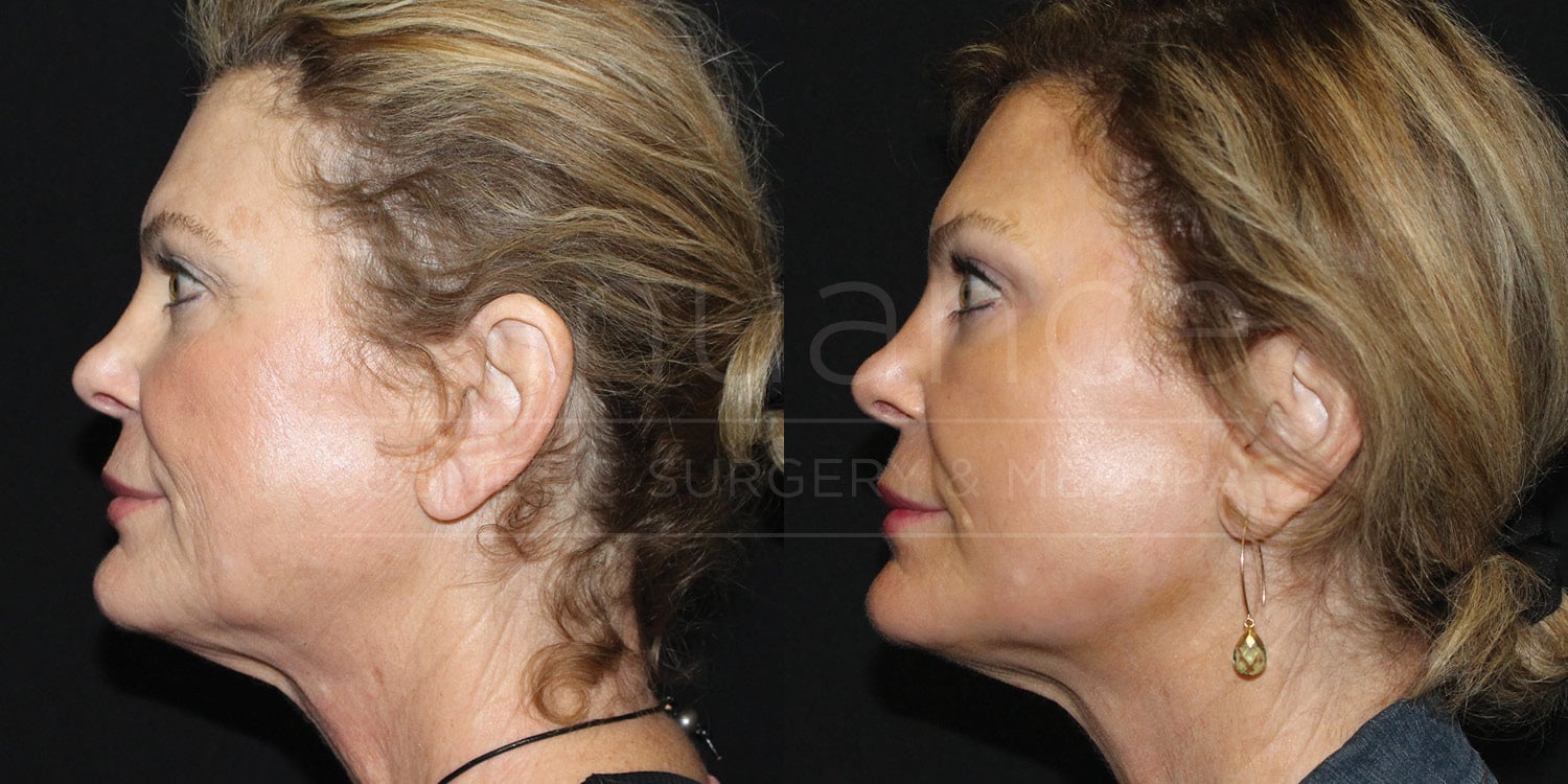 CO2 Laser Resurfacing Before and After photos performed by Dr. Rachel S. Ford