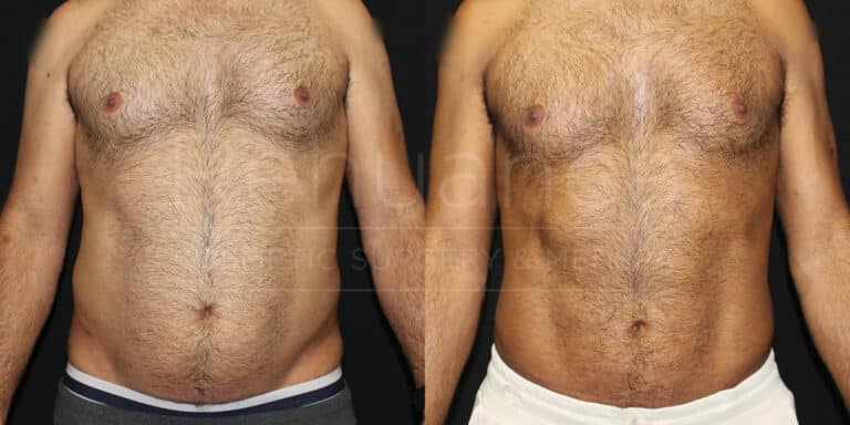 Liposuction of Abdomen Flanks Male Before and After photos performed by Dr. Rachel S. Ford