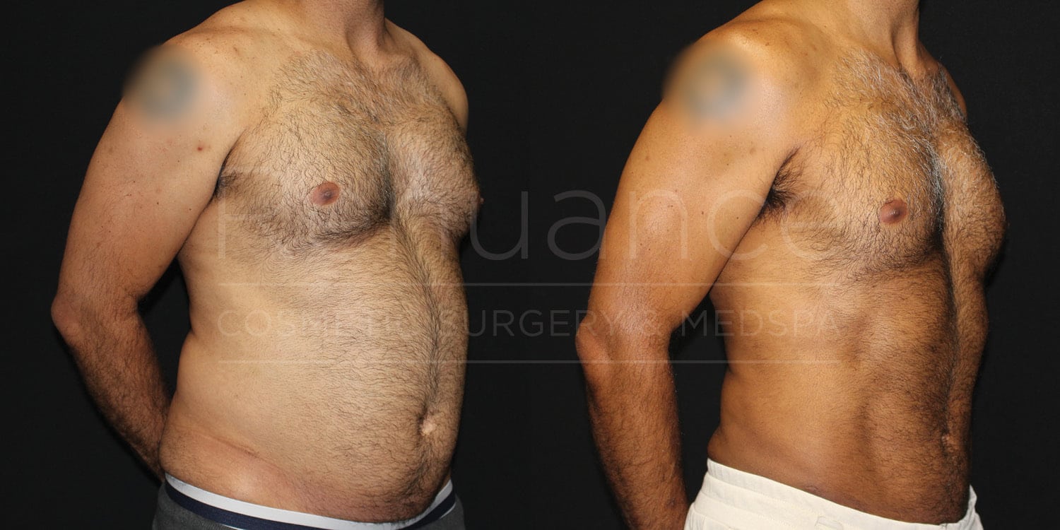 Liposuction of Abdomen Flanks Male Before and After photos performed by Dr. Rachel S. Ford