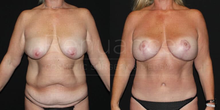 Before and after mommy makeover results - patient from Murrieta
