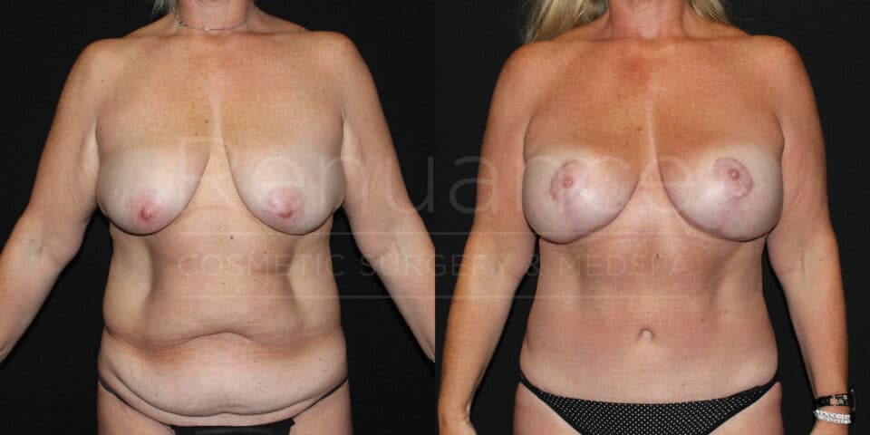 Before and after mommy makeover results - patient from Murrieta