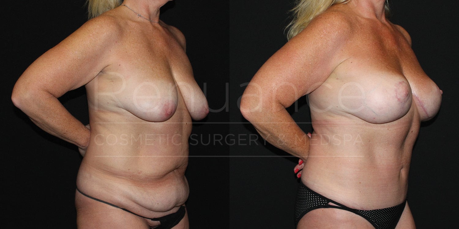 Before and after mommy makeover results from our Temecula clinic showing natural-looking transformation