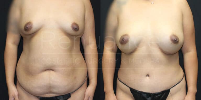 Mommy Makeover Before and After photos performed by Dr. Rachel S. Ford