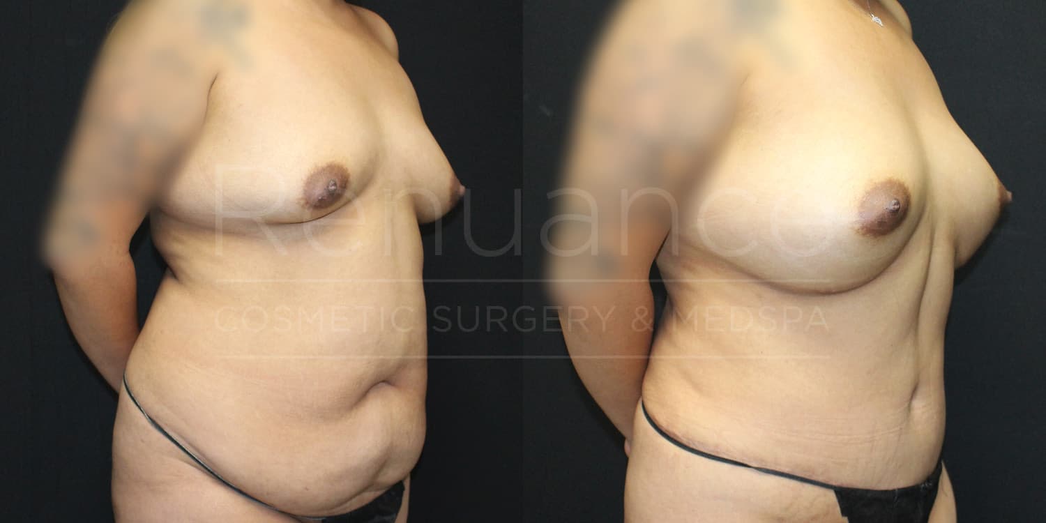 Mommy Makeover Before and After. side view, performed by Dr. Rachel S. Ford