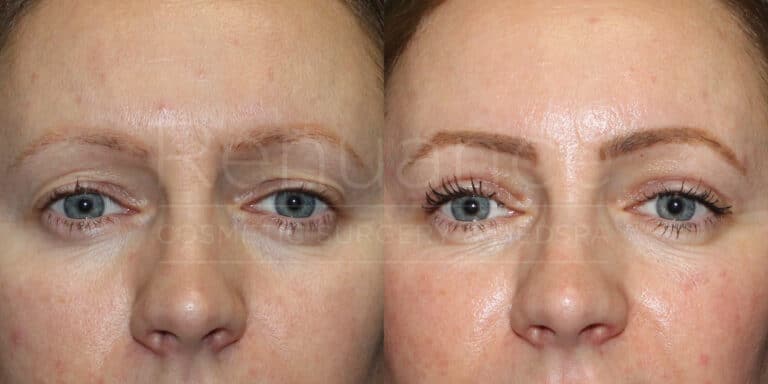 Upper Blepharoplasty Example By Dr. Ford