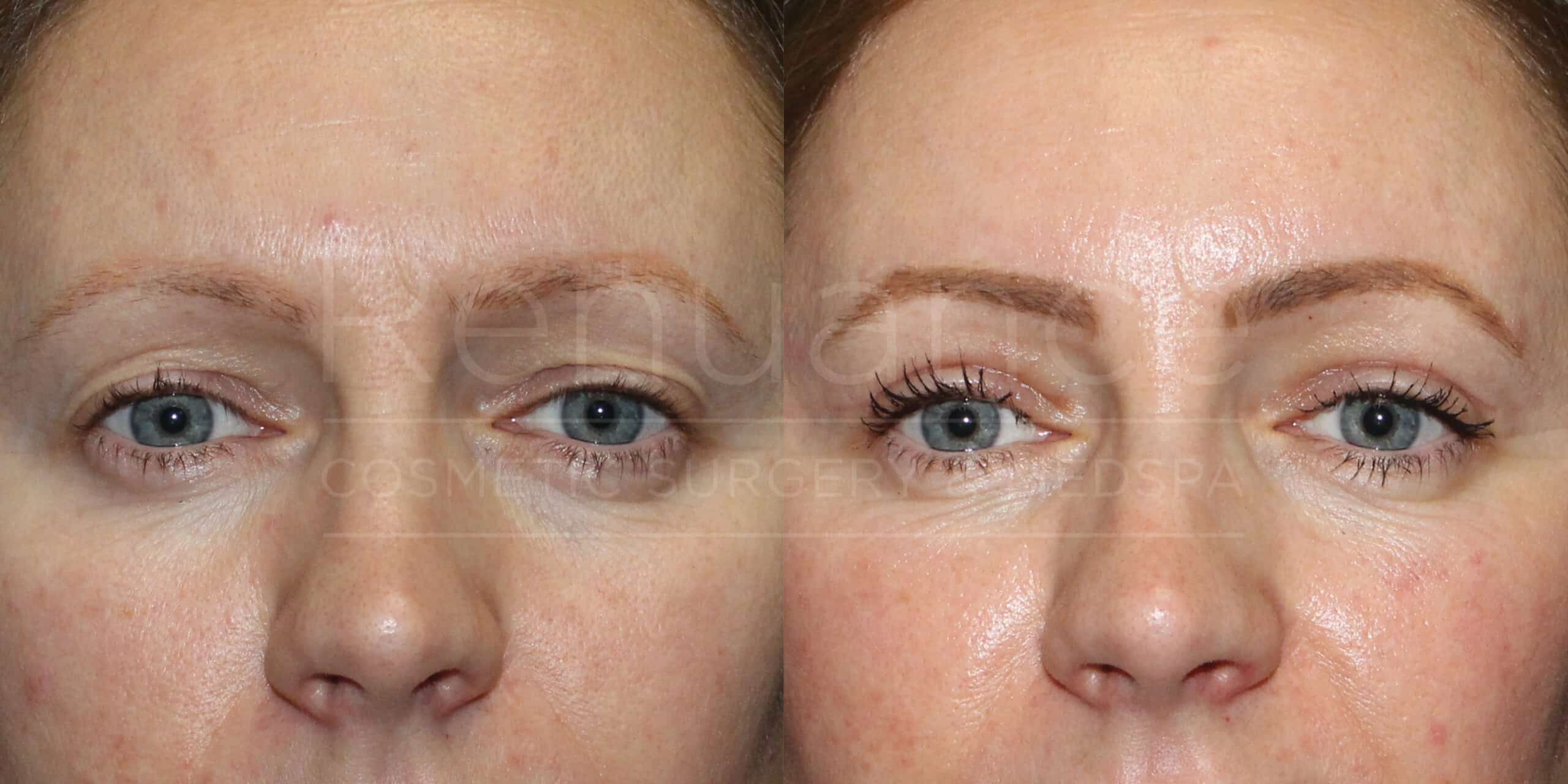 Upper Blepharoplasty Example By Dr. Ford
