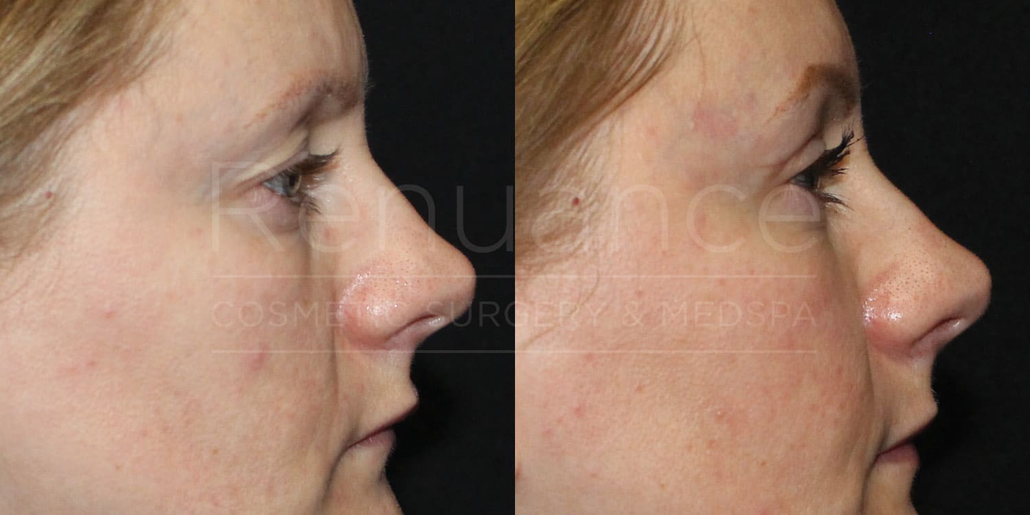 Upper Blepharoplasty Example By Dr. Ford