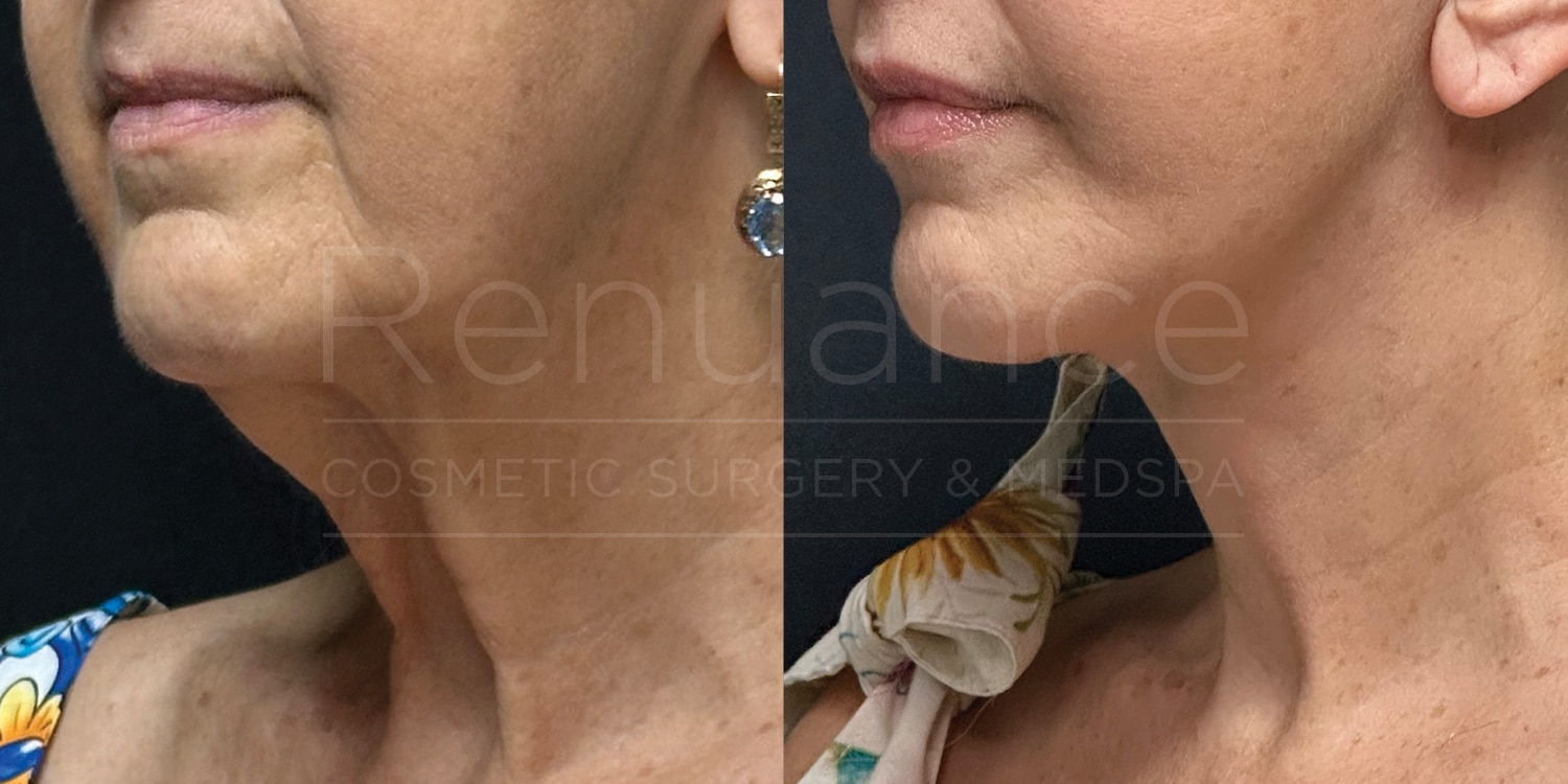 Deep Plane Face/neck Lift, Coronal Brow Lift, Lip Lift, Upper Blepharoplasty, Fat to Lip and Cheeks