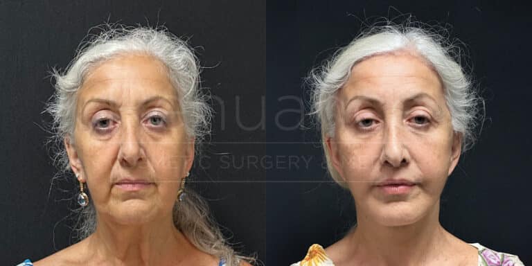 Deep Plane Face/neck Lift, Coronal Brow Lift, Lip Lift, Upper Blepharoplasty, Fat to Lip and Cheeks